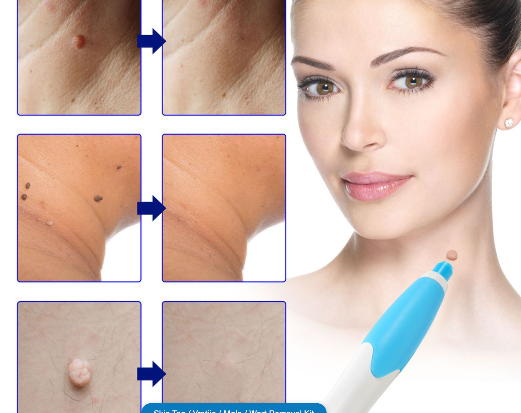 Skin Tag / Vratjie / Mole / Wart Removal Kit